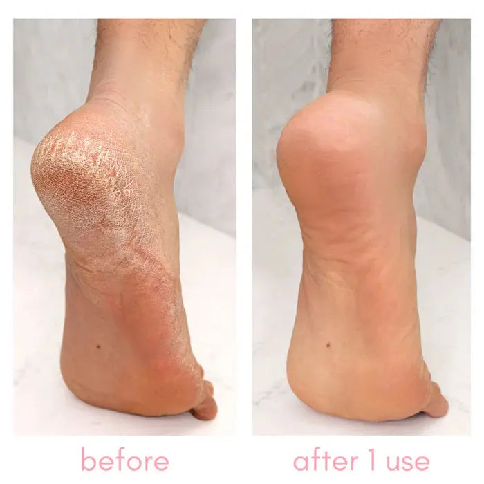Kiara Sky Heel-ing Callus Remover